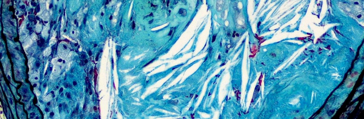 Microscopic view of tissue stained in shades of blue, white, and red, showing fibrous structures and scattered cells. The image displays a textured, marbled appearance with elongated white streaks.