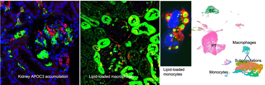Four scientific images: Left shows kidney cells with APOC3 accumulation (blue, red, green). Middle left displays lipid-loaded macrophages (green, red). Middle right highlights lipid-loaded monocytes. Right shows a cell cluster map with labeled subpopulations.